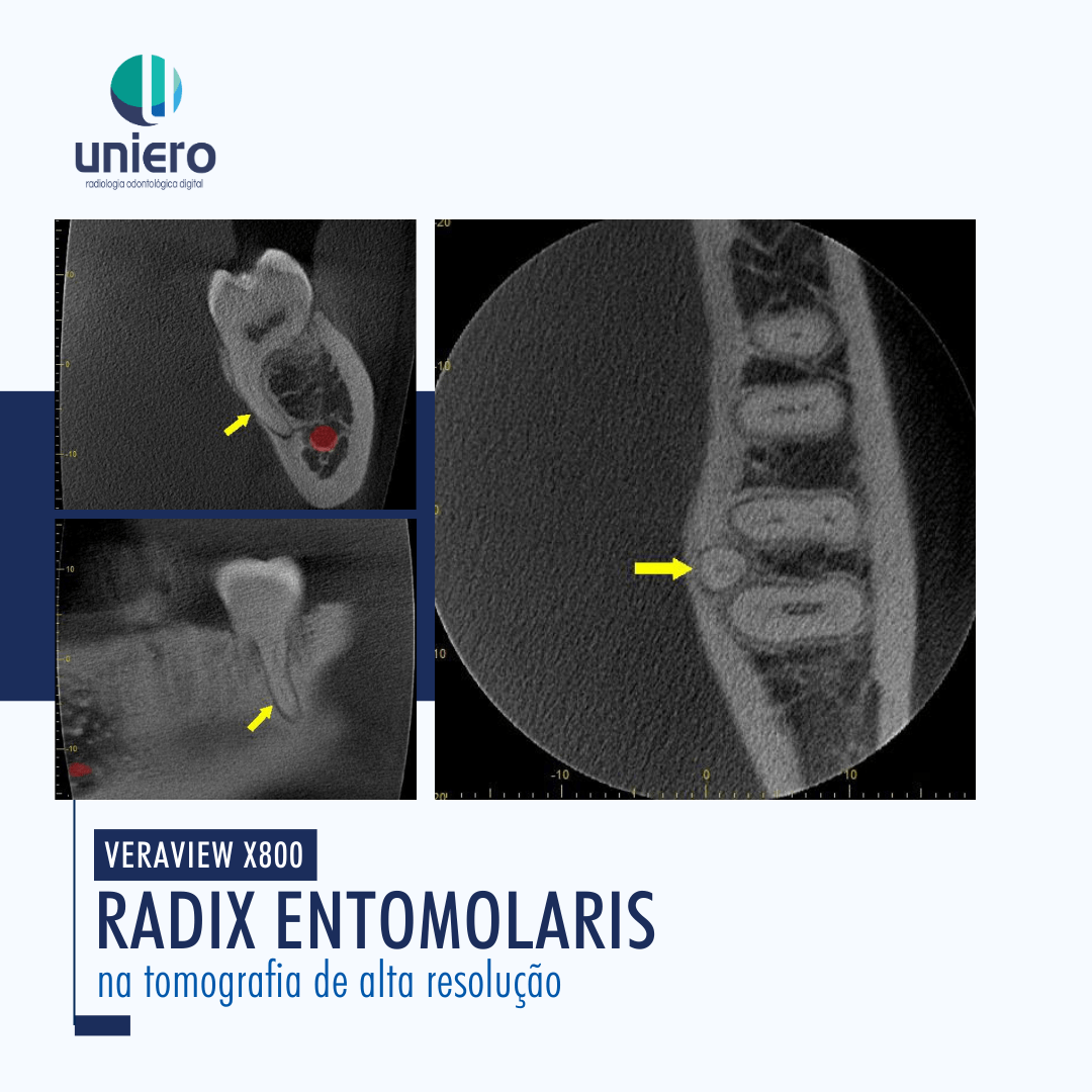Imagens tomográficas de radix paramolaris