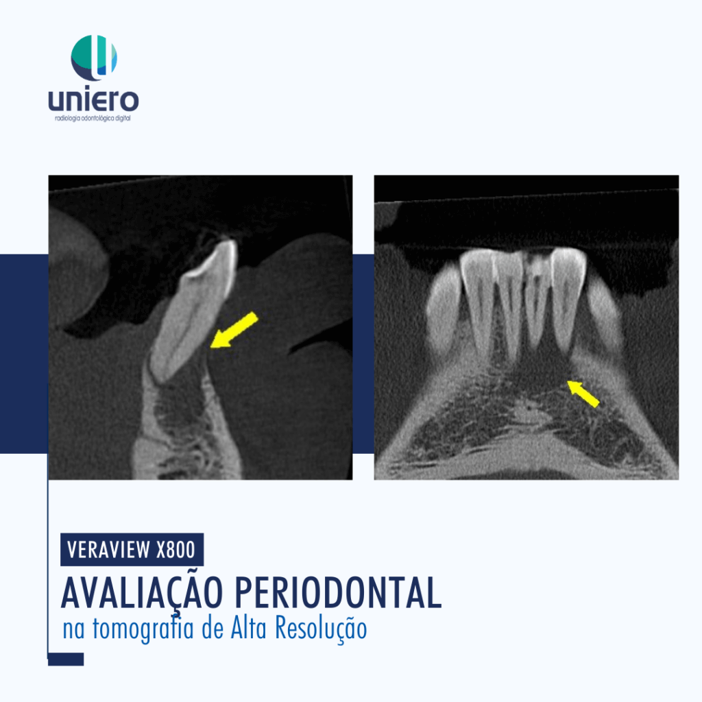 Imagens tomográficas de avaliação periodontal