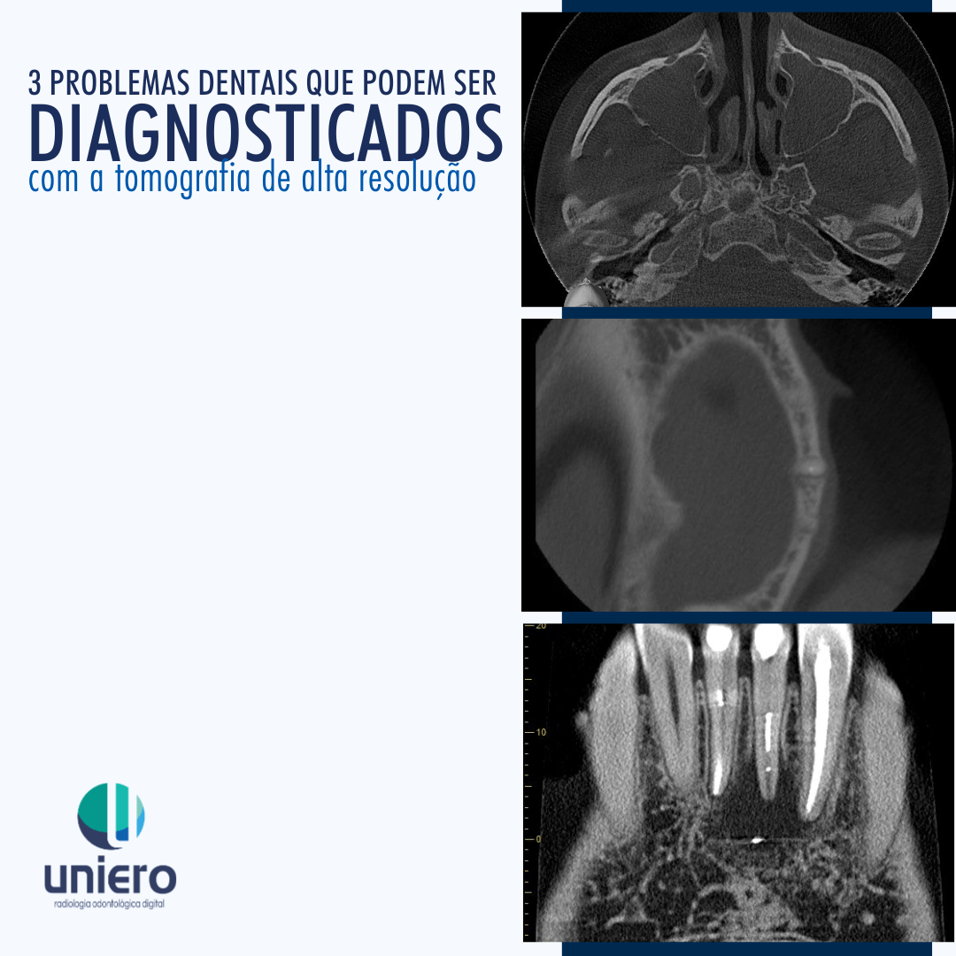 Imagens tomográficas de alta resolução apontando sinusite odontogênica, lesão periapical e traumatismo dentário