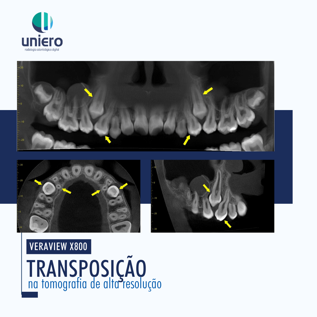 Imagens tomográficas de transposição dentária