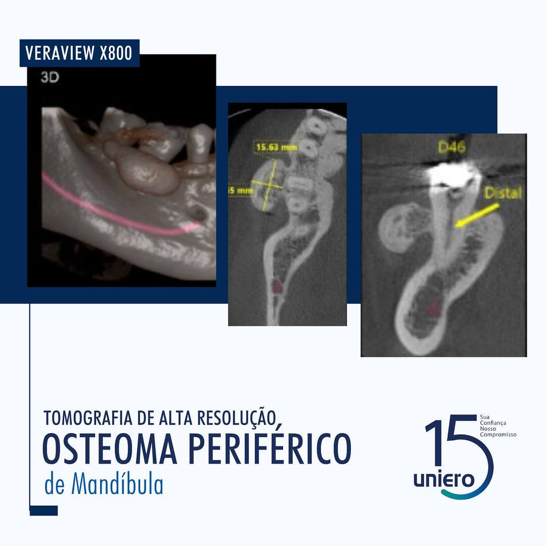 osteoma-periferico-de-mandibula