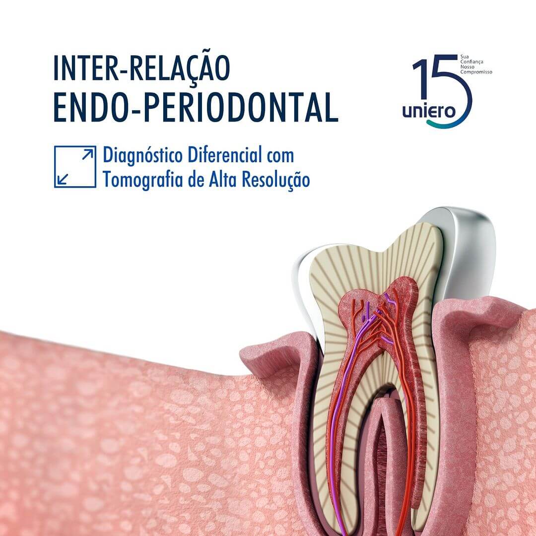 inter-relacao-endo-periodontal