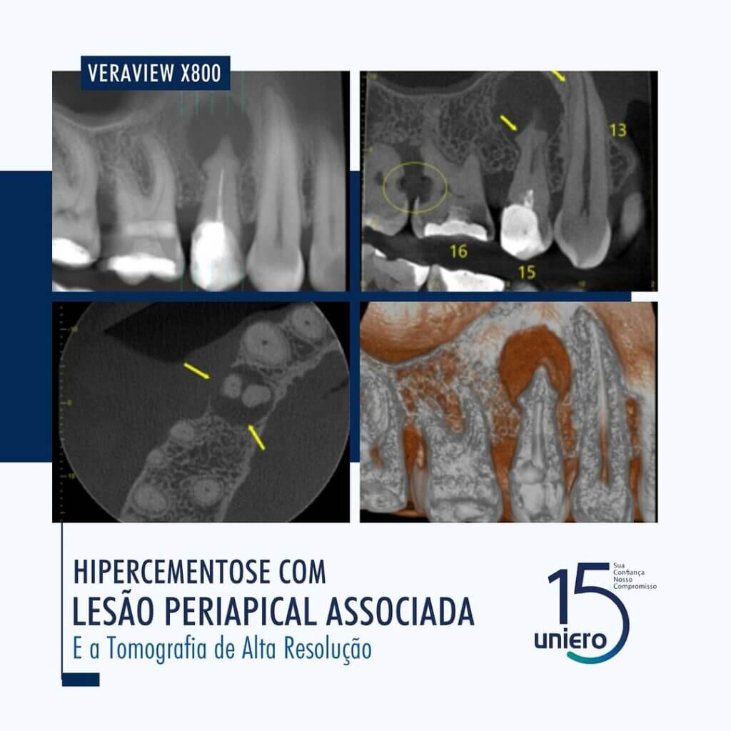 hipercementose-com-lesao-periapical-associada