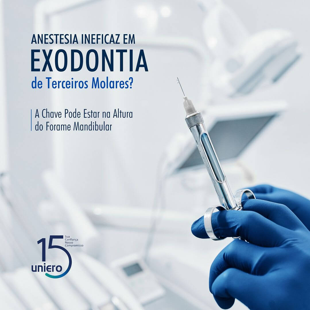 anestesia-ineficaz-em-exodontia-de-terceiros-molares-?