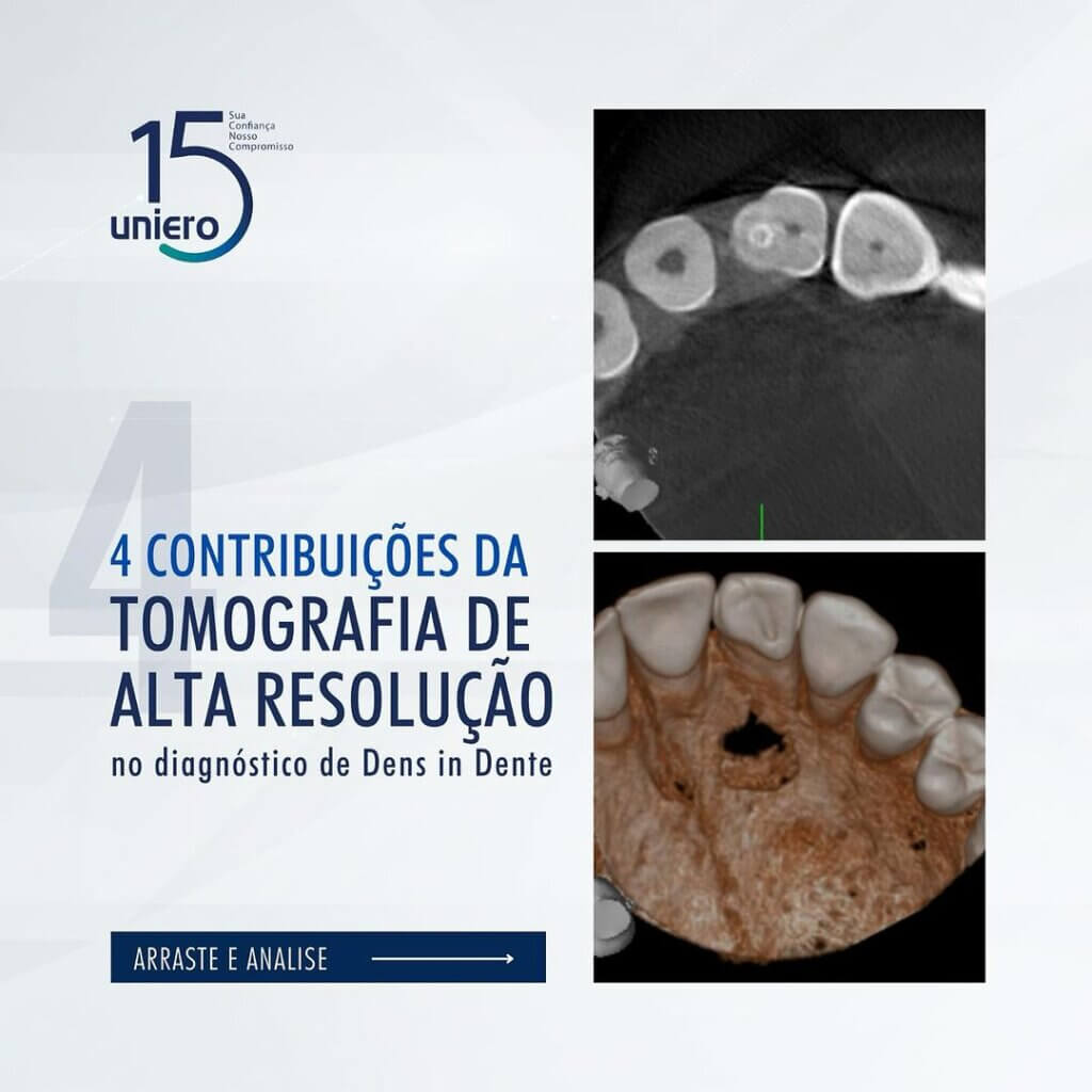 contribuicoes-da-tomografia-de-alta-resolucao