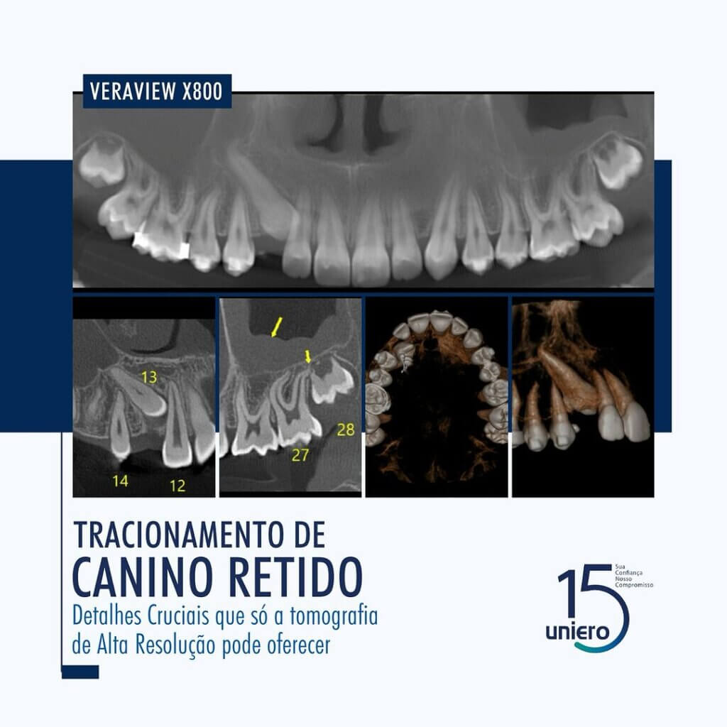 tracionamento-de-canino-retido