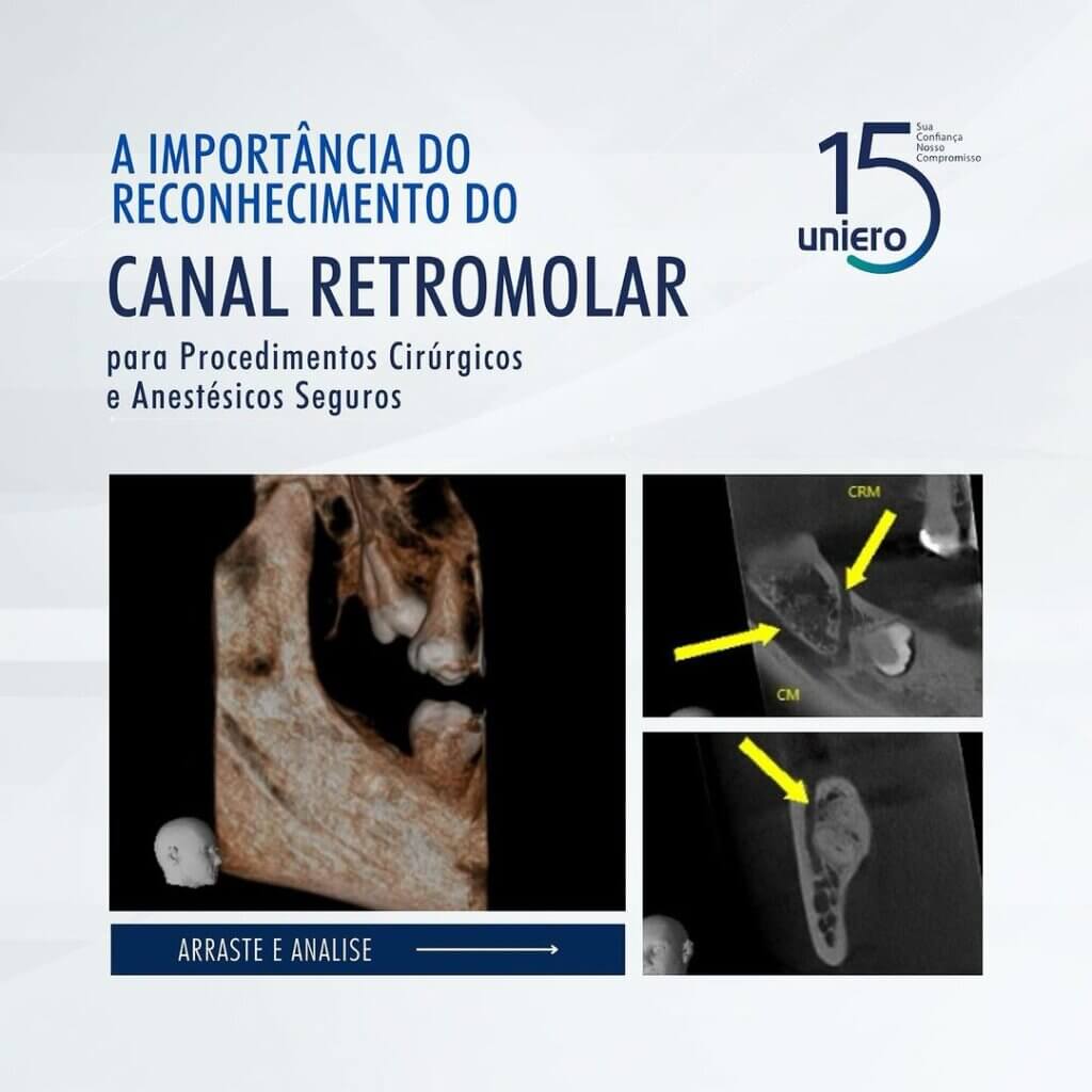 canal-retromolar