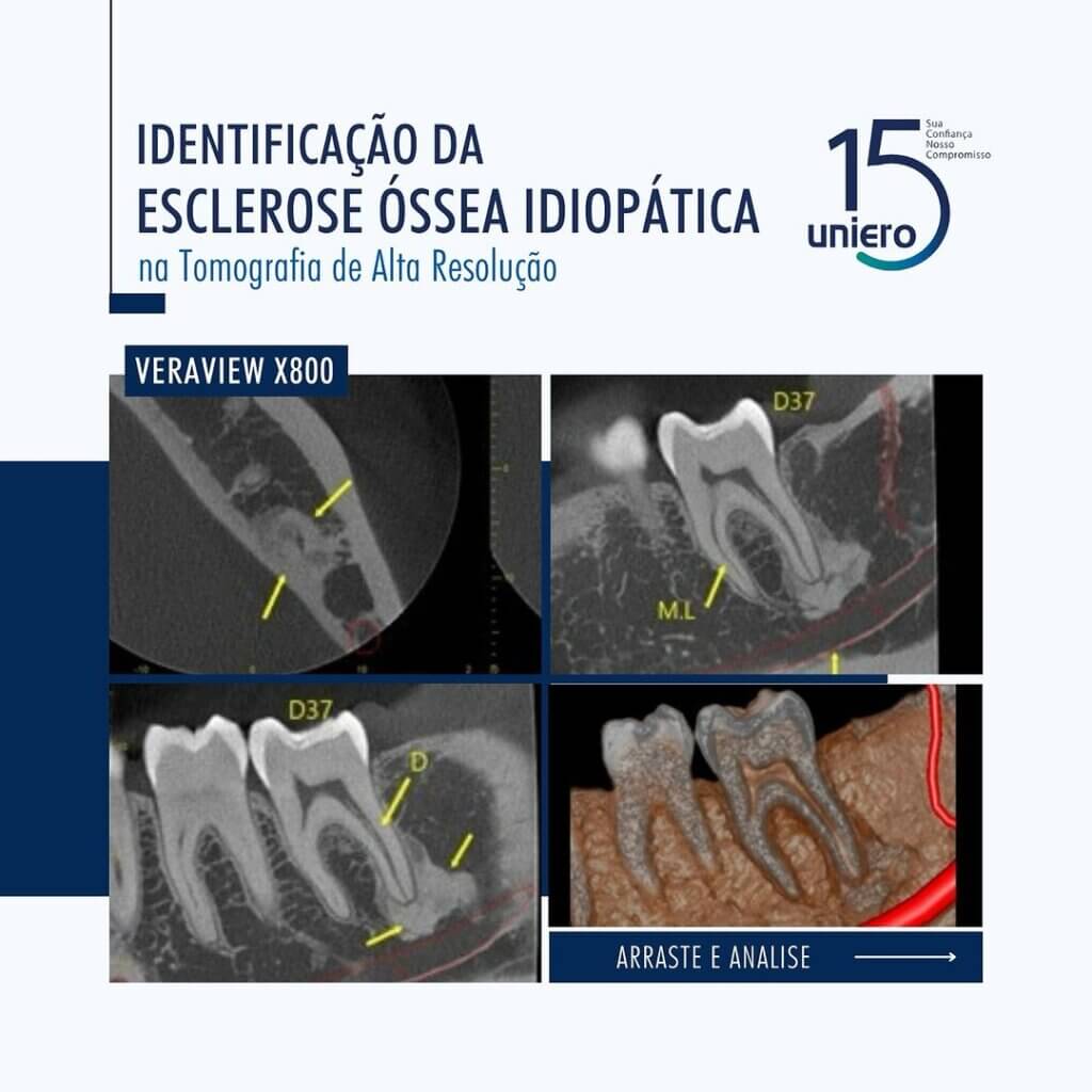 identificacao-da-esclerose-ossea-idiopatica