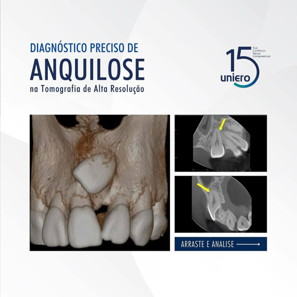 diagnostico-preciso-de-anquilose