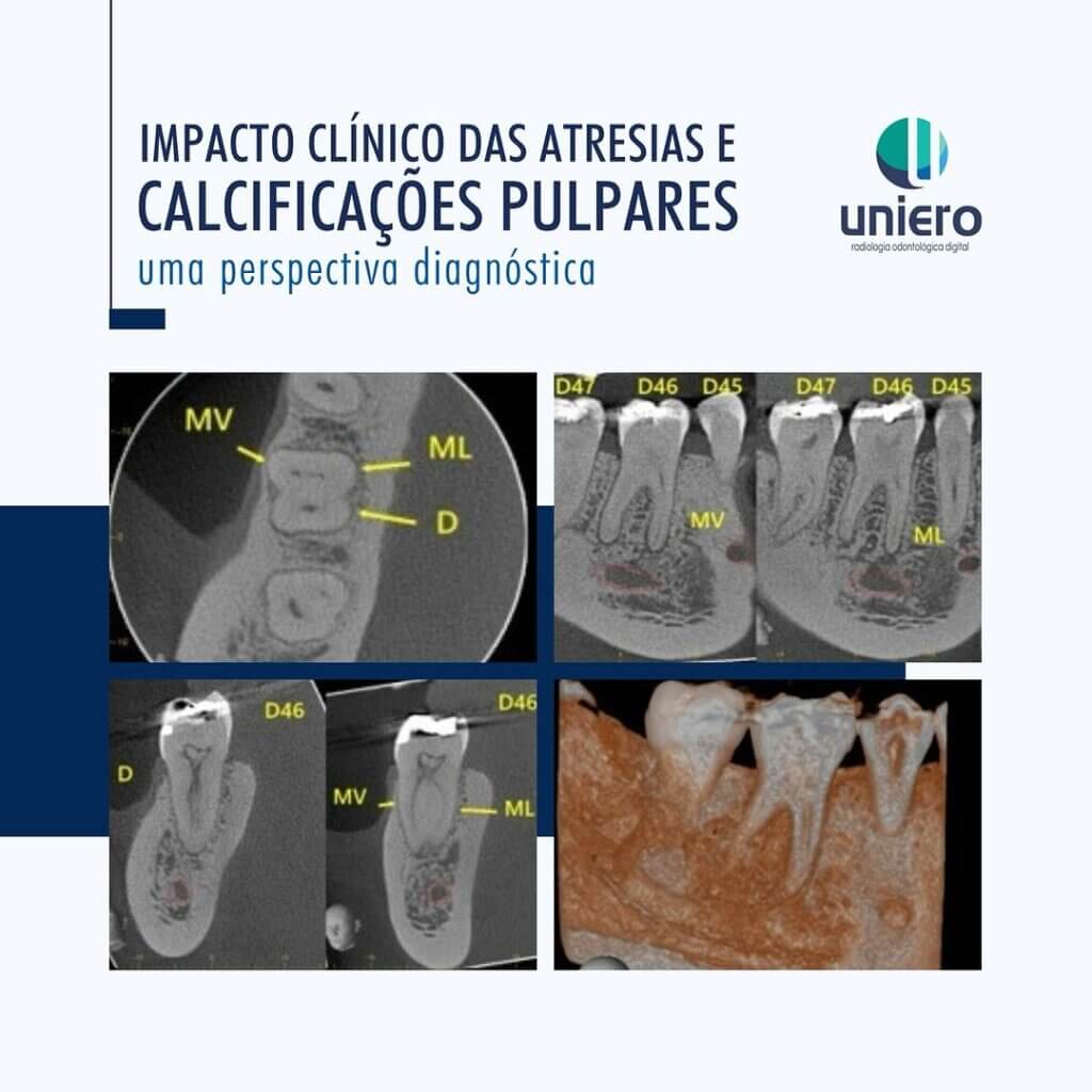 impacto-clinico-das-atresias-e-calcificacoes-pulpares