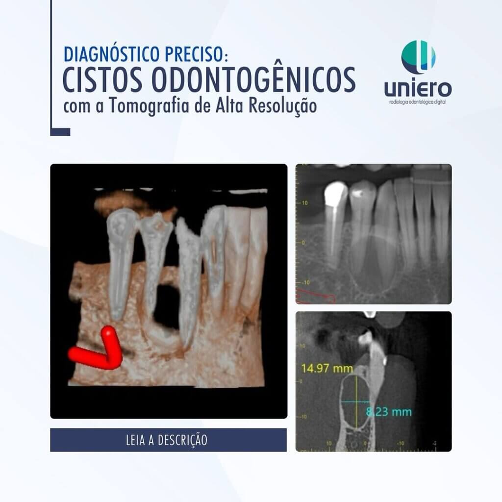 cistos-odontogenicos