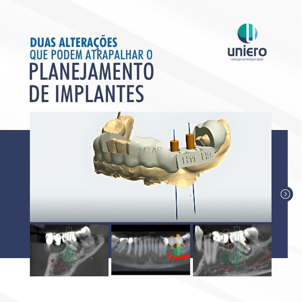 planejamento-de-implantes