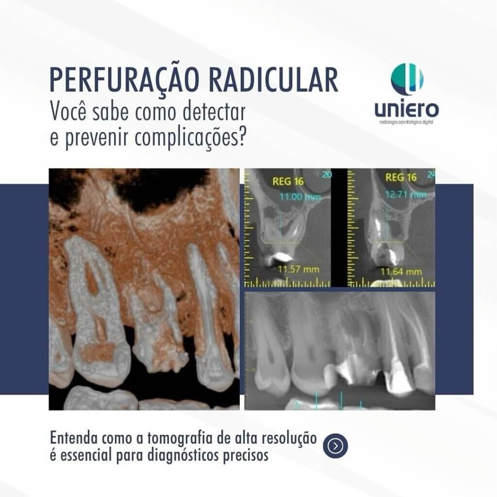 perfuracao-radicular