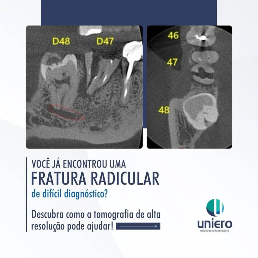 fratura-radicular-de-dificil-diagnostico