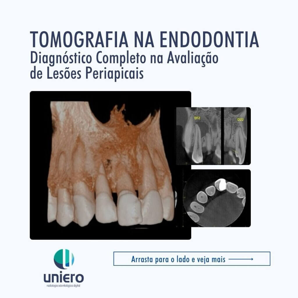 tomografia-na-endodontia