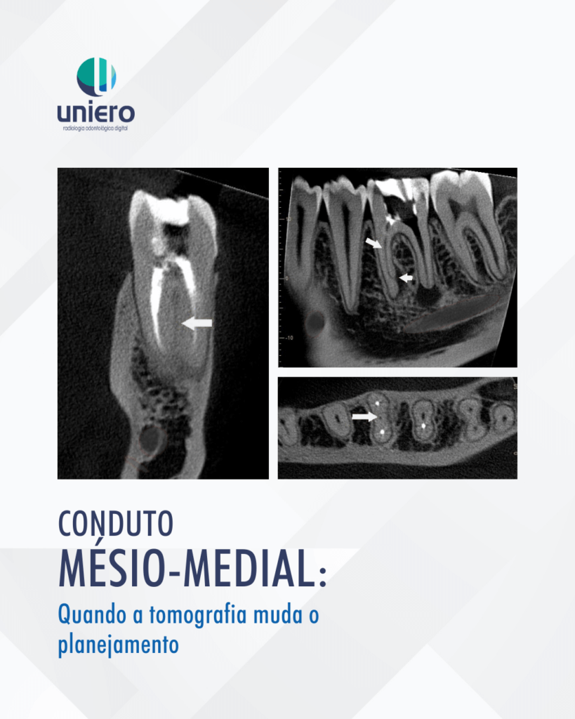 conduto-mesio-medial