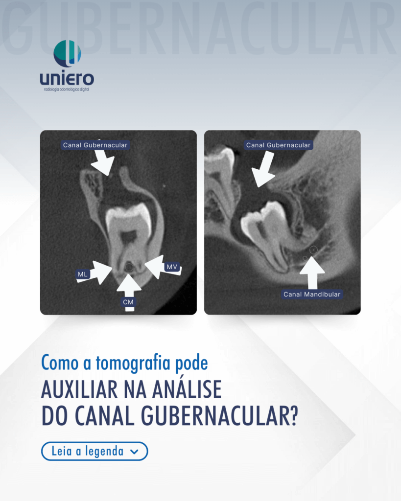 analise-do-canal-gubernacular