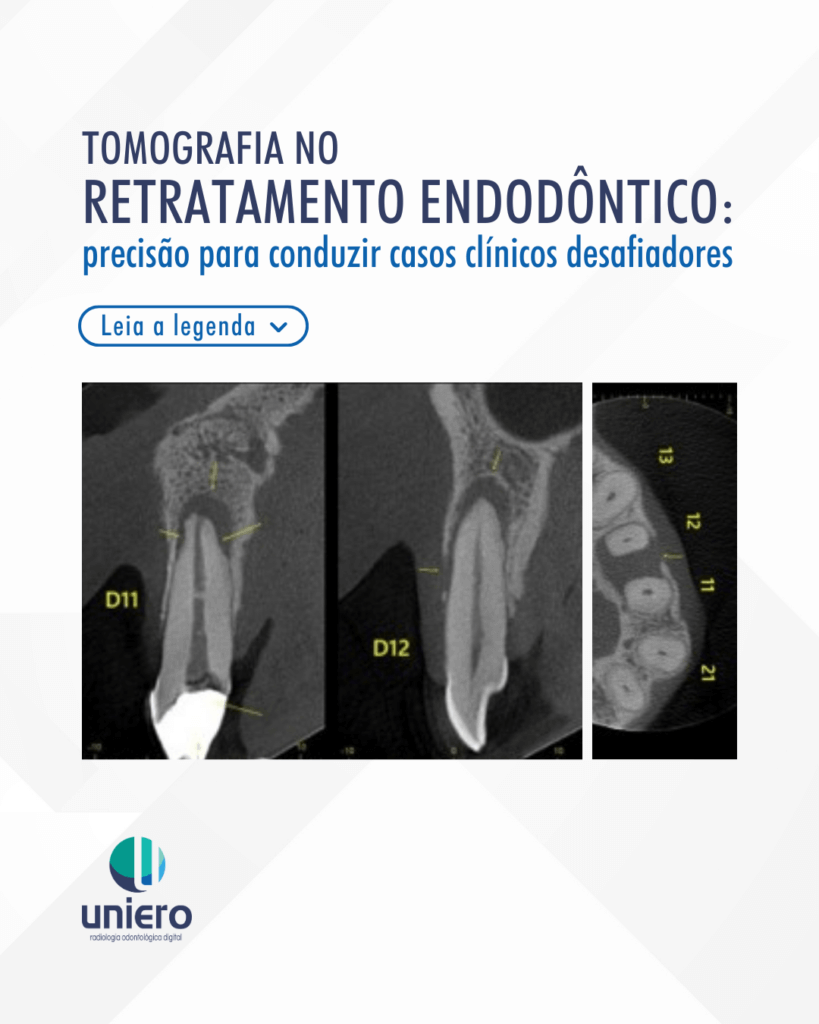 tomografia-no-retratamento-endodontico