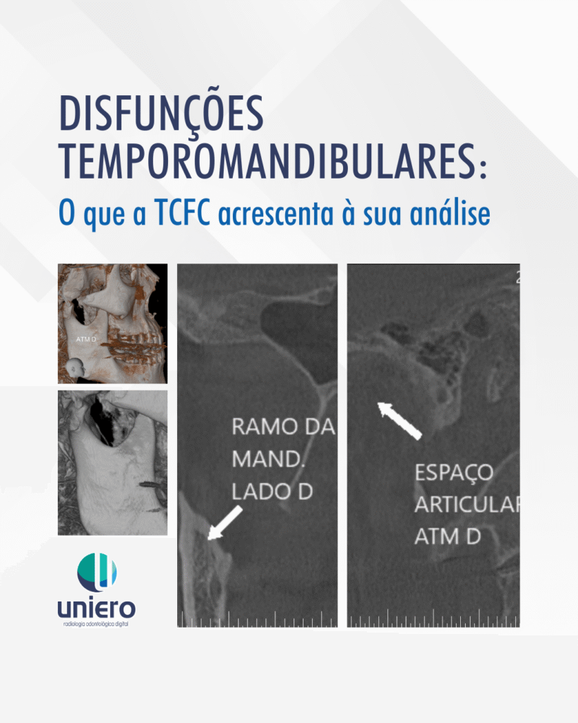 disfuncoes-temporomandibulares