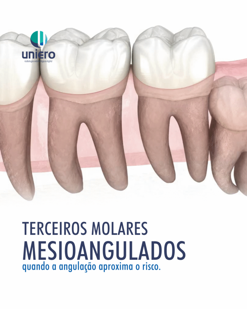 terceiros-molares-mesioangulados