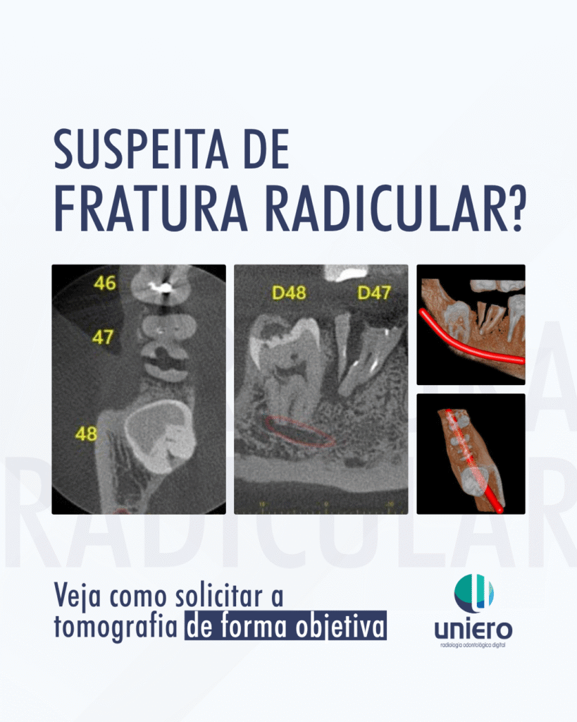 suspeita-de-fratura-radicular