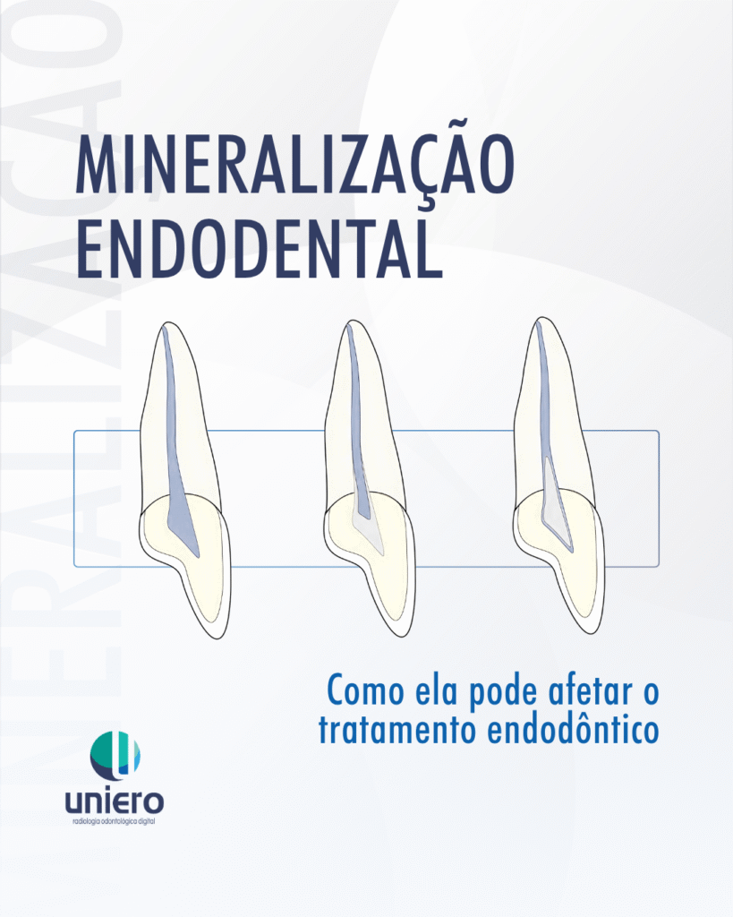 mineralizacao-endodental